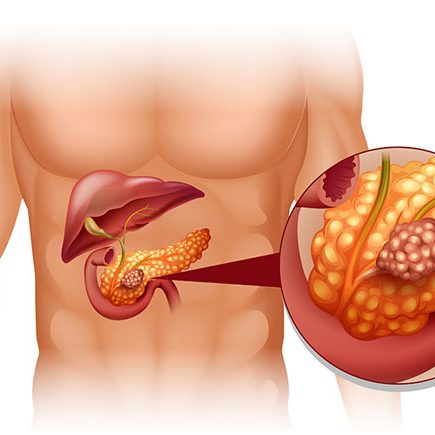 Pancreatic Diseases Overview