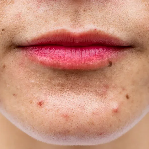 The causes of acne, as well as some treatment options that can help alleviate the symptoms