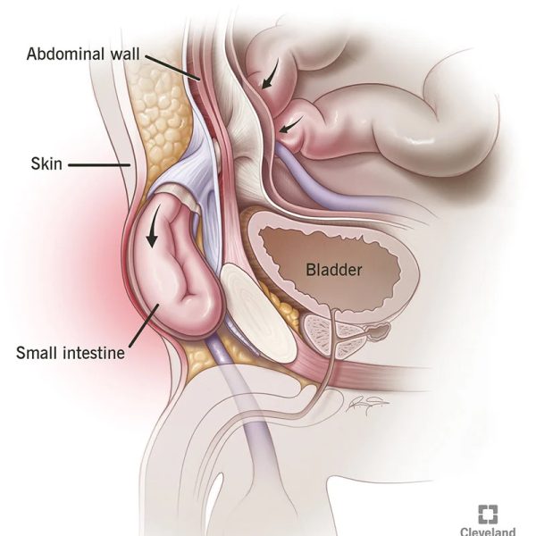 Inguinal Hernia: Symptoms, Diagnosis, and Treatment Options