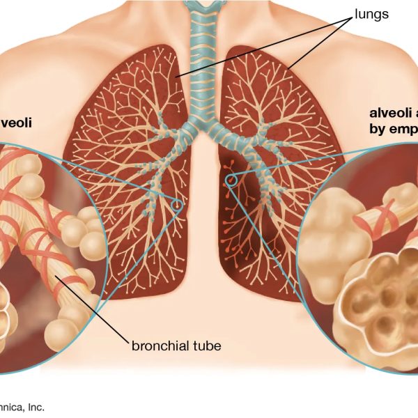 Lung disease