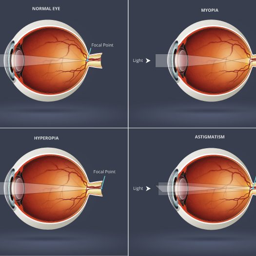 Refractive Errors